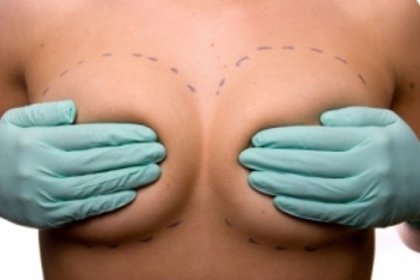 La réduction mammaire: une intervention à la fois esthétique et de confort.