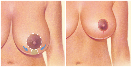 Les diffèrences et points communs entre un lifting des seins et une réduction mammaire