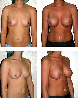 La chirurgie des seins pour avoir une nouvelle poitrine