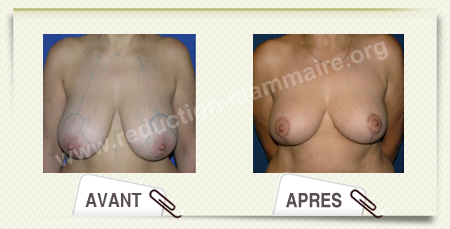 reduction mammaire photo