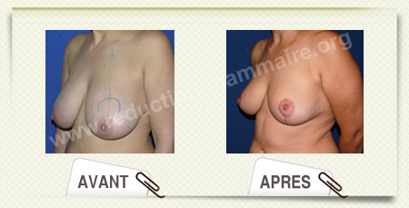 reduction mammaire photo