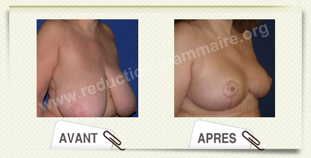 photo reduction mammaire
