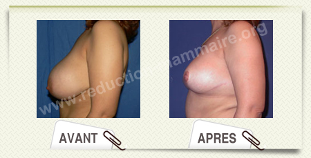 reduction mammaire avant apres
